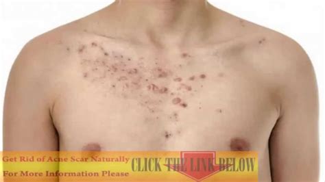 How To Get Rid Of Chest Acne Best Acne Treatments Acne