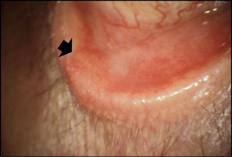 Inverted Conjunctival Papilloma A Certainly Underestimated High Risk