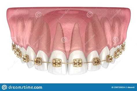 Golden Braces Tretament Macro View Medically Accurate Dental 3d