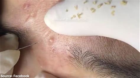 Worst Case Removal Blackheads On The Face Easy How To Remove