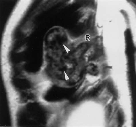 Chest Wall Tumors Radiologic Findings And Pathologic Correlation