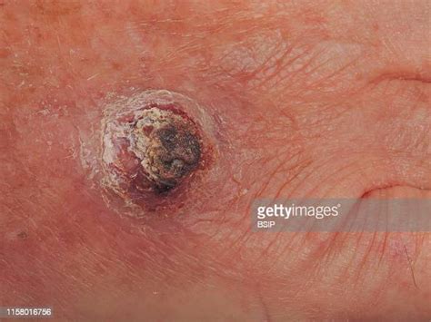 Invasive Squamous Cell Carcinoma Of The Hand News Photo Getty Images