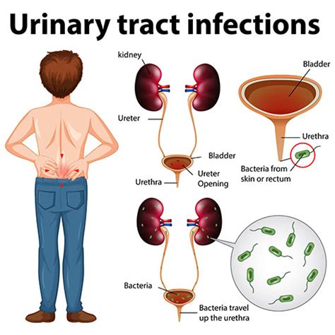 Urinary Tract Infection In Men Symptoms Causes And Treatment Metromale Clinic Fertility Center