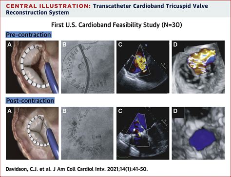 Early Feasibility Study Of Cardioband Tricuspid System For Functional