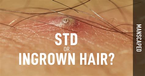 Std Or Ingrown Hair Manscaped