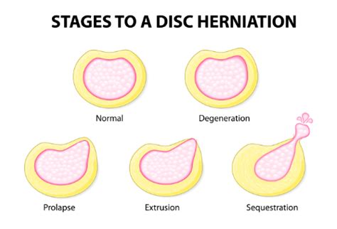 Bulging Disc Vs Herniated Disc Whats The Difference Can