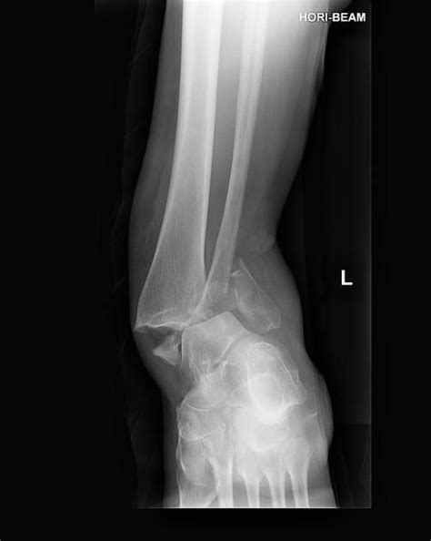Fracture Dislocation Of The Ankle Radiology Case