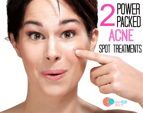 2 Power Packed Acne Spot Treatments Using Just 2 Ingredients Diy Skin