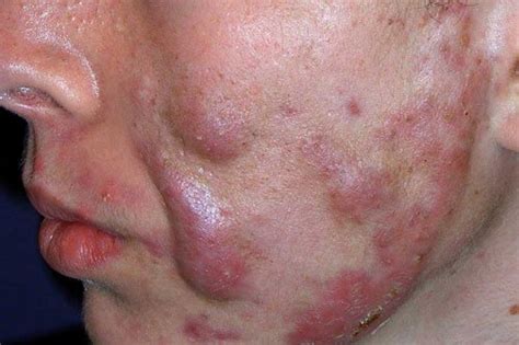Cystic Acne Treatment In Sg Cure Inflamed Recurring Acne