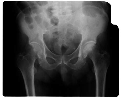 Osteoarthritis Hip X Ray Findings