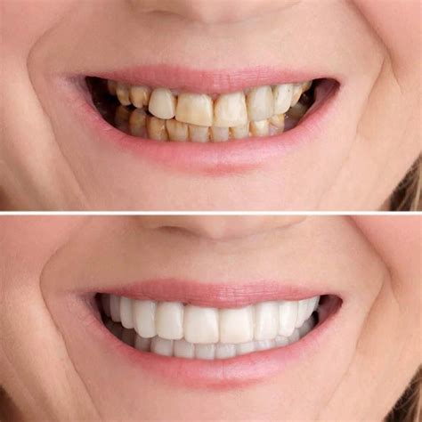 1 Pair Fake Teeth Whiting Smile Beauty Tool Silicon Perfect Fit Teeth
