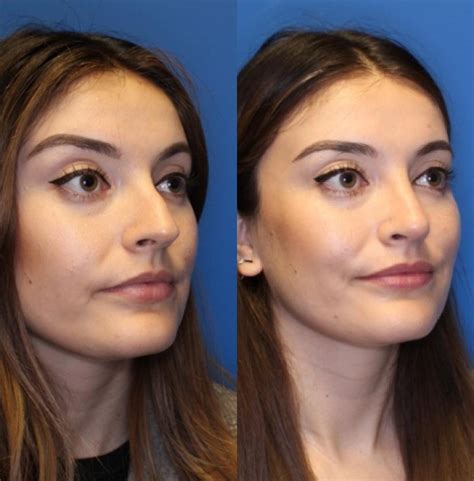Nose Surgery Before And After Photos Patient 234 San Francisco Ca