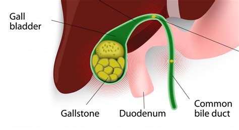 What Causes A Dilated Bile Duct With Pictures