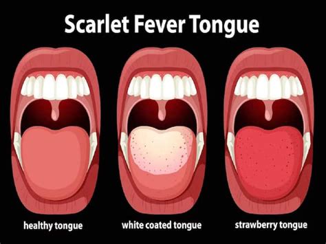 Scarlet Fever Know The Common Signs And Symptoms Of This Bacterial