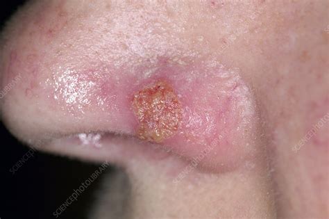 Cold sores, also known as herpes labialis, are caused by nongenital herpes simplex virus type 1. Cold sore - Stock Image - M170/0342 - Science Photo Library