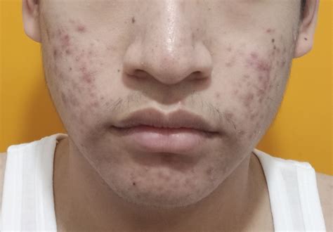 Excessive Acne Breakout From Working General Acne Discussion Forum