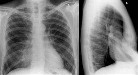 If the condition is severe, it can look like the middle of the chest is scooped out, creating a deep hole. Pectus Excavatum