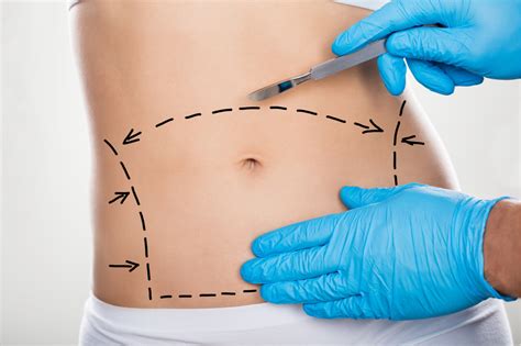 Many times your new belly button will be too small, or maybe a bit misshapen at first. Miami - The Cheapest State for Tummy Tuck ...