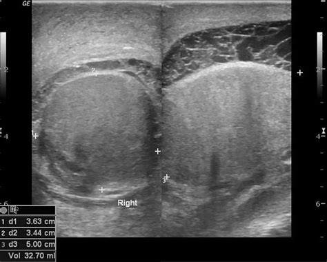 Orchitis Causes Symptoms Diagnosis Treatment