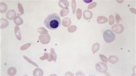 Drépanocytose Quelles Sont Les Règles Dhygiène De Vie à Suivre Le