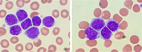 Mantle Cell Lymphoma With Lymphocyte Aggregates In Peripheral Blood
