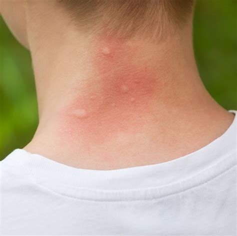 Mosquito Bite Allergy Symptoms Mosquito Bite Reaction Meaning