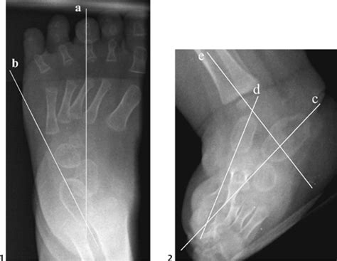 It is the commonest anomaly affecting the feet diagnosed on antenatal ultrasound. 87 Congenital Equinovarus or Clubfoot | Radiology Key