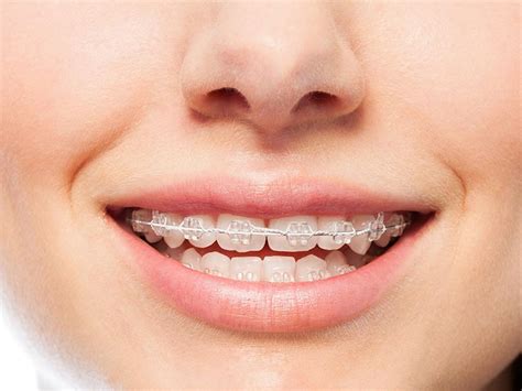 Adult Treatment Morley Orthodontic Clinic