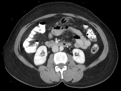 Computed Tomography Ct Of Abdomen Horizontal View Showing