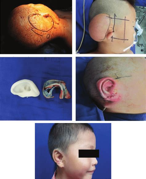 Process Of Ear Reconstruction Download Scientific Diagram