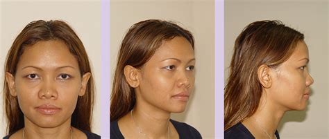 dr chettawut sex reassignment and facial feminization surgery center asian nose augmentation