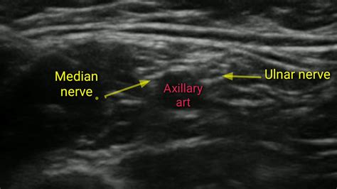 Ultrasound Guided Axillary Brachial Plexus Block Youtube