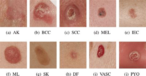 Types Skin Lesion Chart