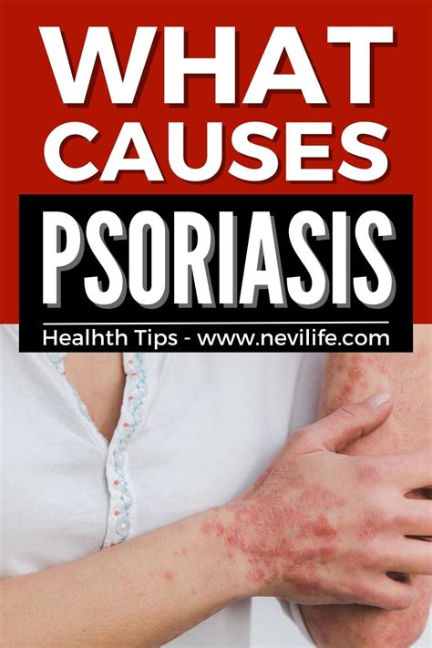 What Causes Psoriasis Nevilife