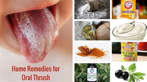 8 Best Home Remedies For Oral Thrush