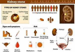 Kidney Stones Associated Urological Specialists
