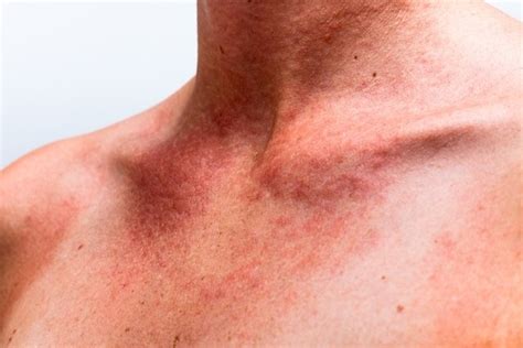 Síntomas De Alergia Al Sol Tratamiento Y Cómo Protegerse Tua Saúde