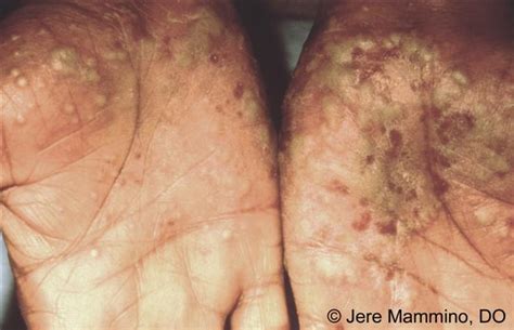 Palmoplantar Pustulosis American Osteopathic College Of Dermatology Aocd