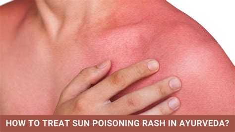 How To Treat Sun Poisoning Rash In Ayurveda