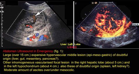 Liver Hemangiosarcoma Abdomen Ultrasound In Emergency Fig 1