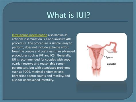 Ppt What Is Iui Or Intrauterine Insemination Powerpoint Presentation Id10596012