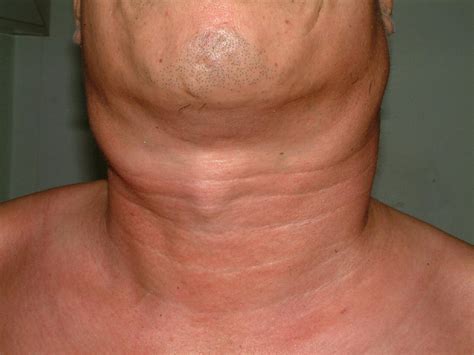 Castlemans Disease Of The Neck Report Of 4 Cases With Unusual