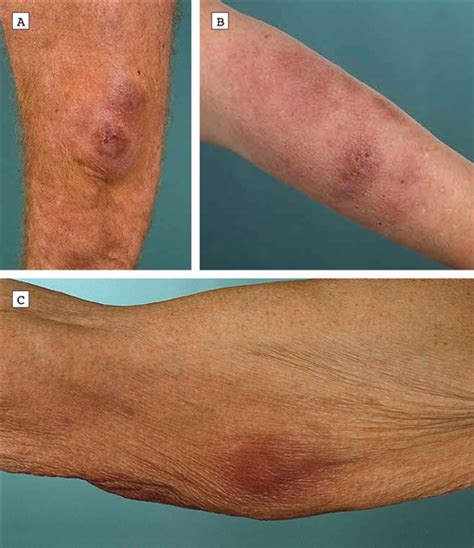 Cd56 Lymphoma With Skin Involvement Clinicopathologic Features And