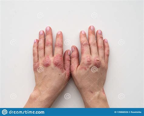 Psoriasis Skin Closeup Of Rash And Scaling On The Patient S Skin The