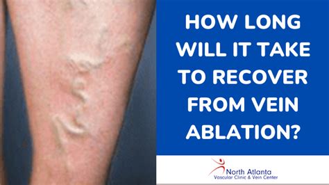 How Long Will It Take To Recover From Vein Ablation