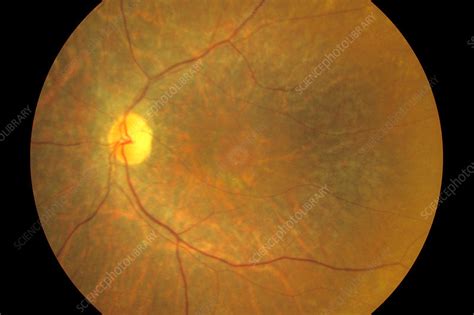 Retinal Cone Rod Dystrophy Fundus Image Stock Image C0345909