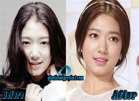 Park Shin Hye Plastic Surgery Styletrust