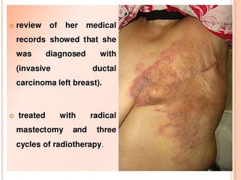 Cutaneous Metastasis Of Breast Cancer