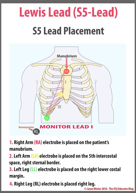 A Lewis Lead Also Called The S5 Lead Is A Modified Grepmed