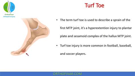 Turf Toe Injury Artofit
